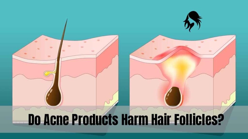 Do Acne Products Harm Hair Follicles? 