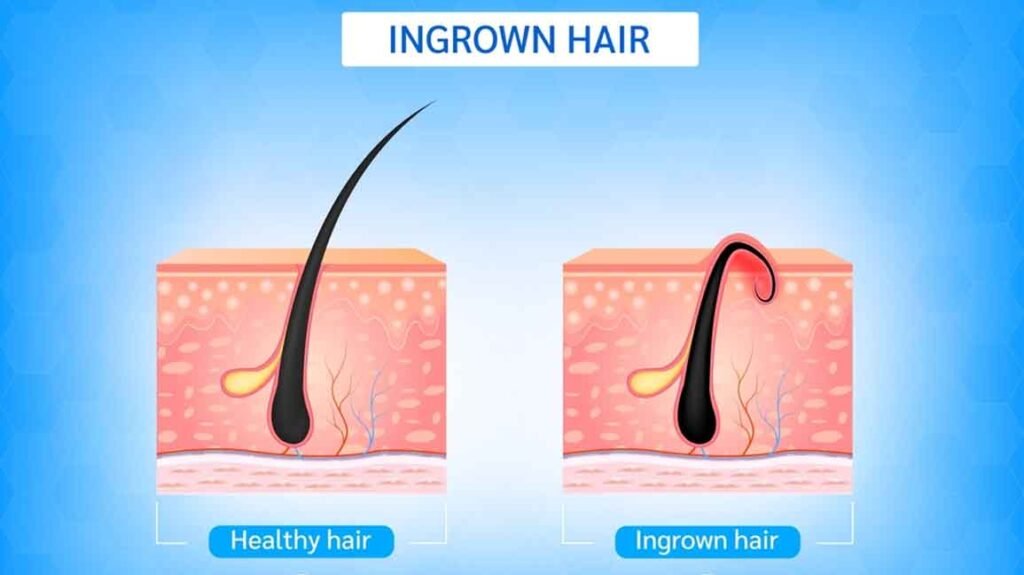 Can I Get Waxed with Ingrown Hairs
